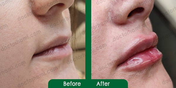 تزریق ژل لب در یزد | فیلر لب در یزد