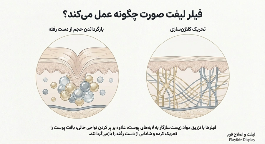 فیلر لیفت صورت