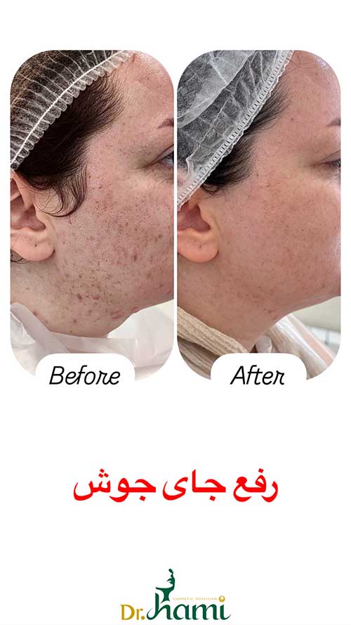 رفع جای جوش - دکتر احسان حامی فر