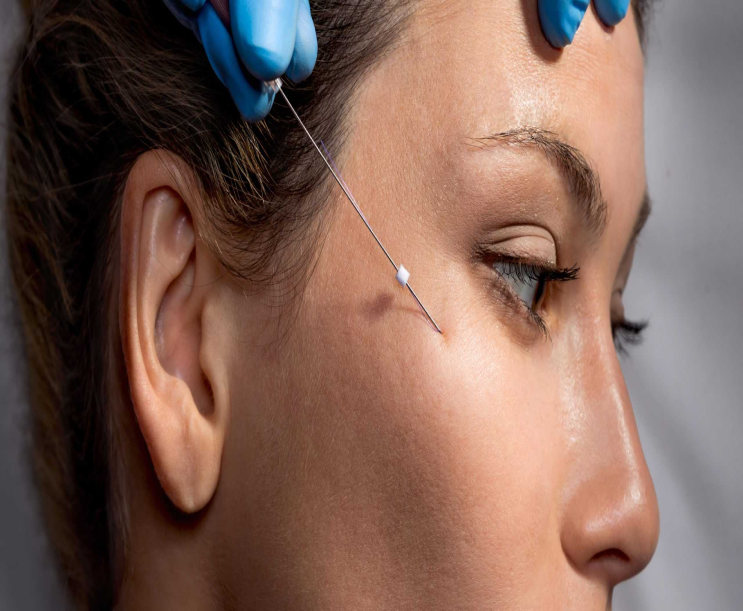 درمان ورم بعد از لیفت با نخ در خانه؛ نکات و مراقبت‌ها