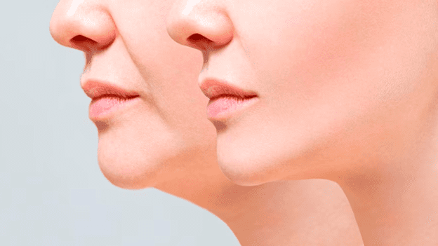 آیا امکان از بین بردن سریع غبغب وجود دارد؟