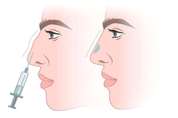 تزریق فیلر بینی مقایسه قبل و بعذ از انجام
