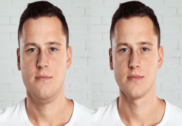 مراقبتهای قبل و بعد از رفع غبغب