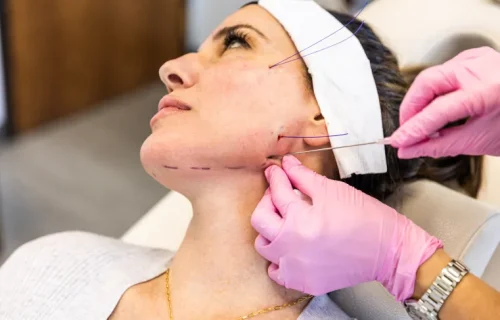 لیفت صورت با نخ بهتر است یا بوتاکس