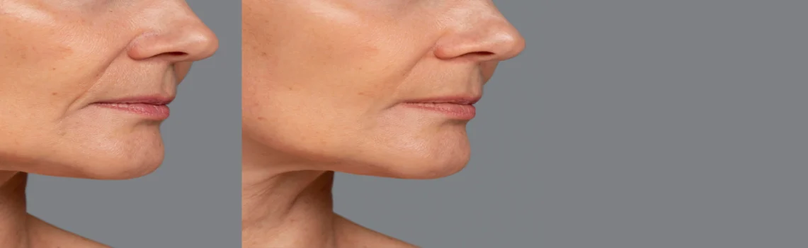 بهترین پزشک برای برداشتن غبغب